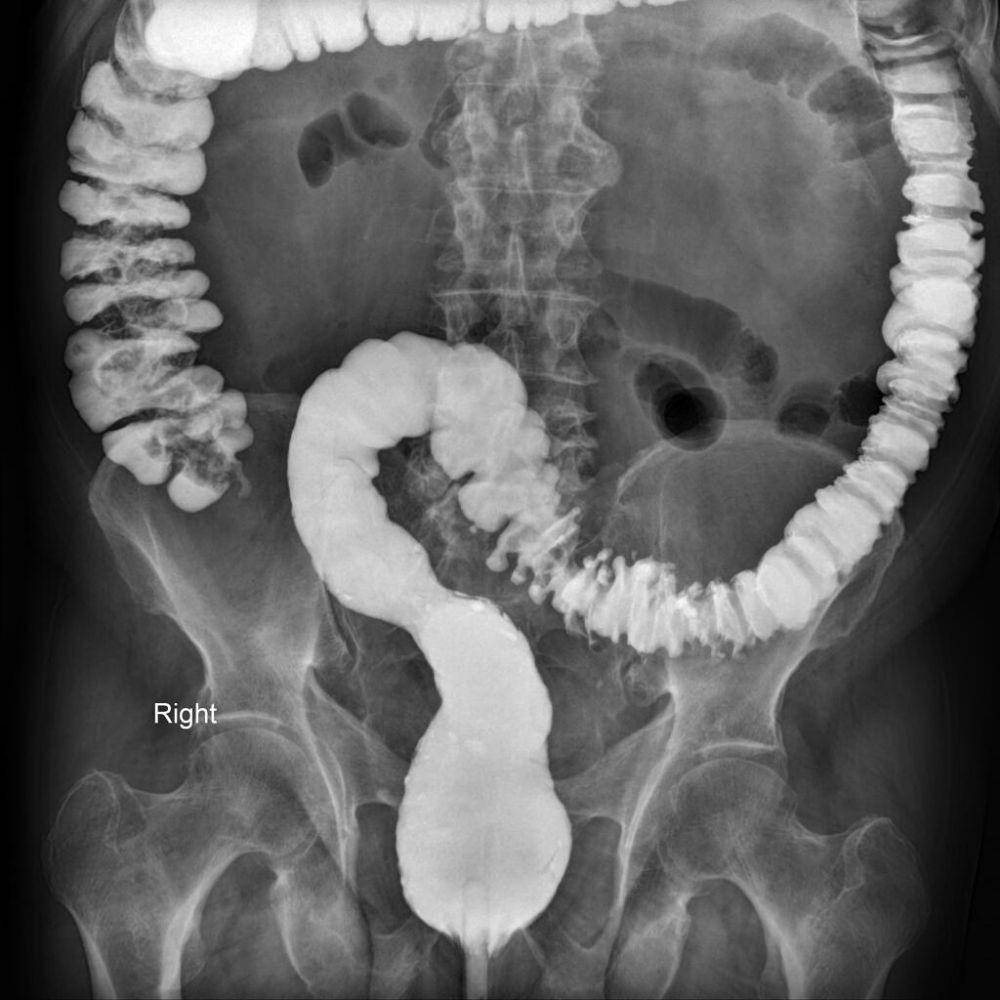 ilustrasi hasil gambar barium enema (radiopaedia.org)