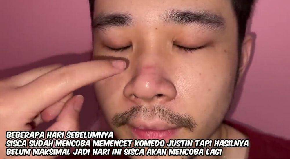 Sisca Kohl membersihkan komedo Jess No Limit. (youtube.com/Jess No Limit)