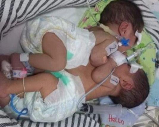 Miliki Satu Organ Hati, Bayi Kembar Siam di Subang Butuh Biaya Operasi