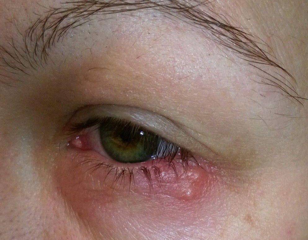 ilustrasi infeksi herpes pada mata (commons.wikimedia.org/Powerfloh)