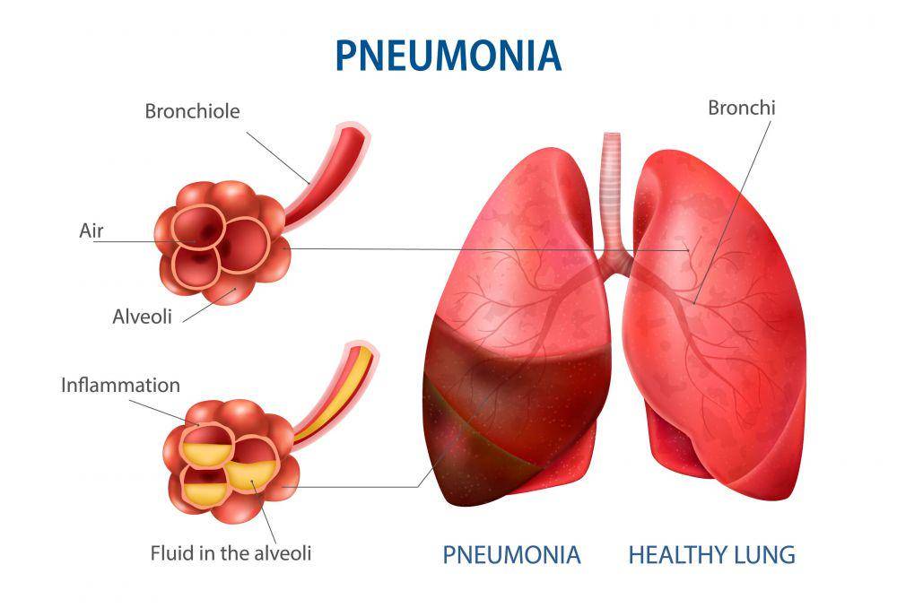 ilustrasi pneumonia (freepik.com/macrovector)