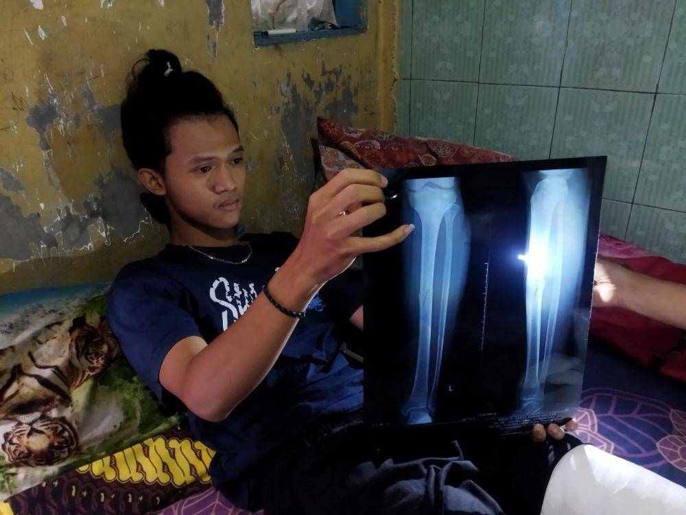 Bagus saat menunjukkan CT scan cedera kaki yang ia alami. Dok/istimewa