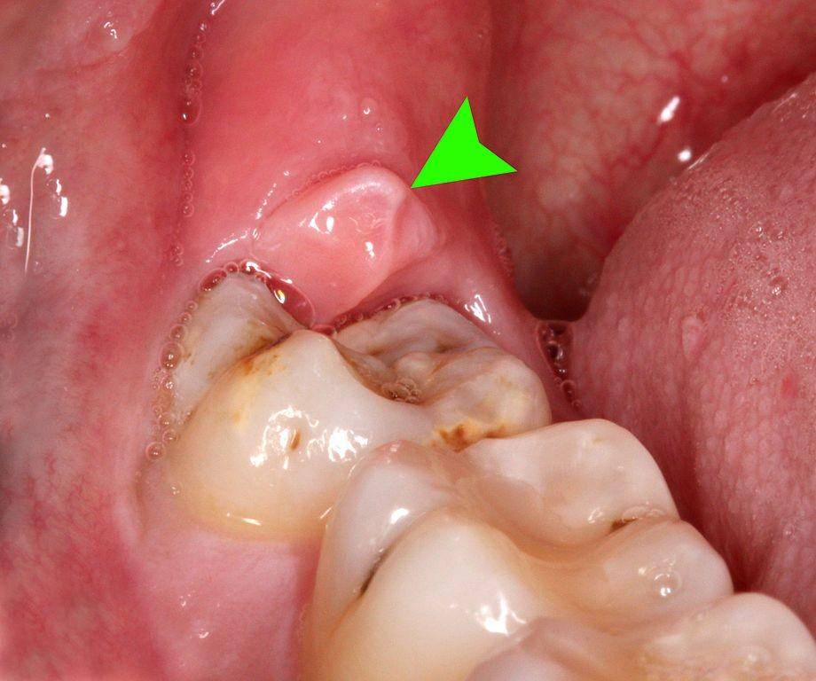 ilustrasi perikoronitis (commons.wikimedia.org/Coronation Dental Specialty Group)