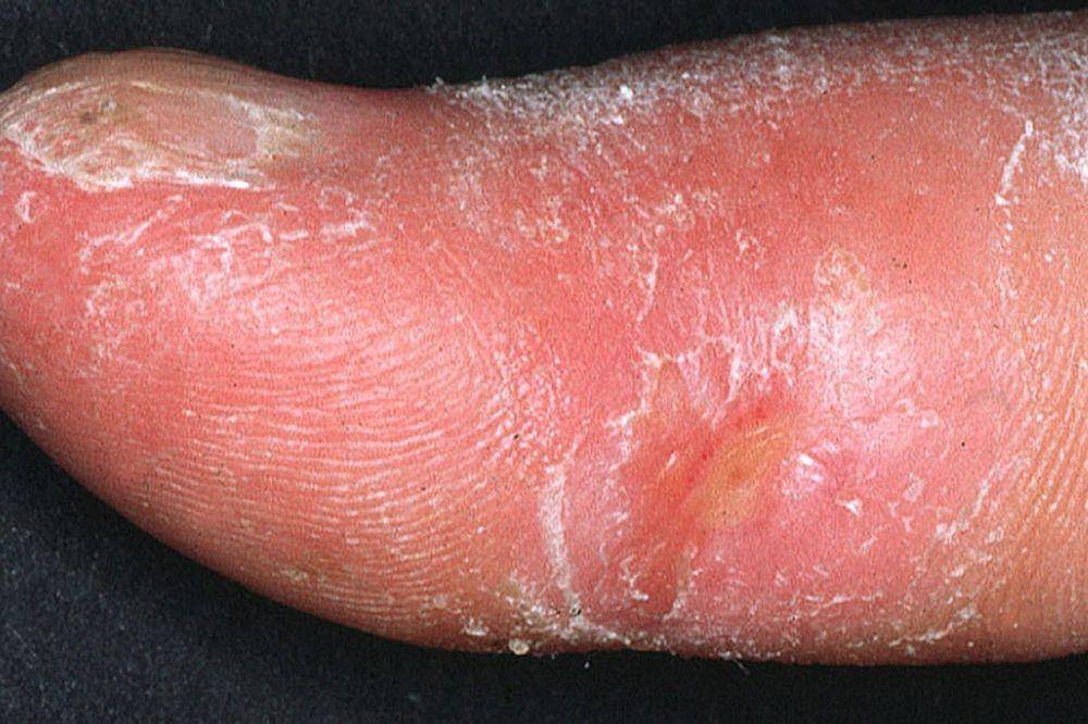 ilustrasi skleroderma (commons.wikimedia.org/Frank Breuckmann, Thilo Gambichler, Peter Altmeyer and Alexander Kreuter)