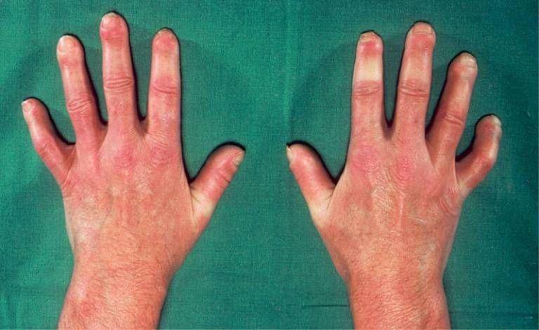 ilustrasi skleroderma (ucl.ac.uk)