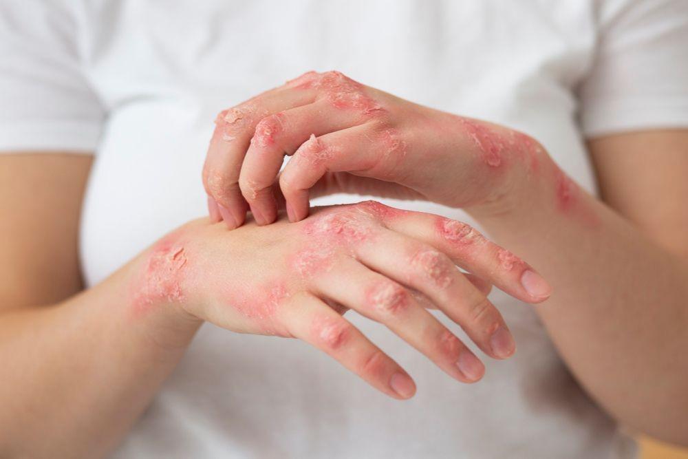 TBC Kulit: Gejala, Penyebab, Diagnosis dan Pengobatan