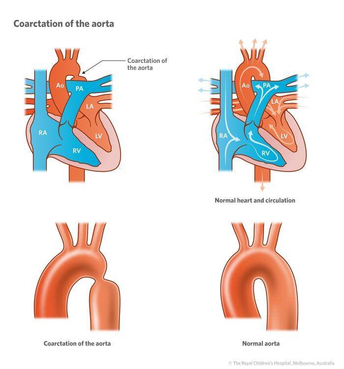 ilustrasi koarktasio aorta (rch.org.au)