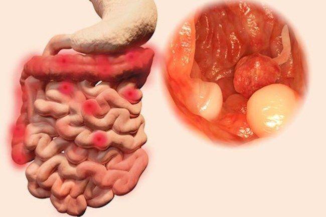 ilustrasi polip usus (healthnavigator.org.nz)