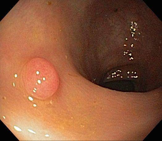 ilustrasi polip usus adenoma (commons.wikimedia.org/Samir)