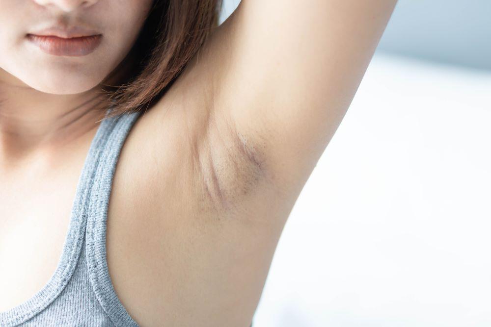Tips Menyulap Ketiakmu yang Berwarna Gelap Menjadi Lebih Cerah
