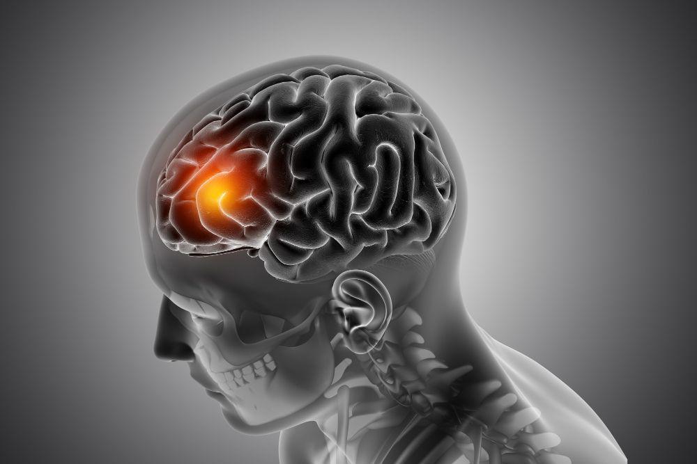 Mengapa Seseorang Bisa Mengalami Stroke?