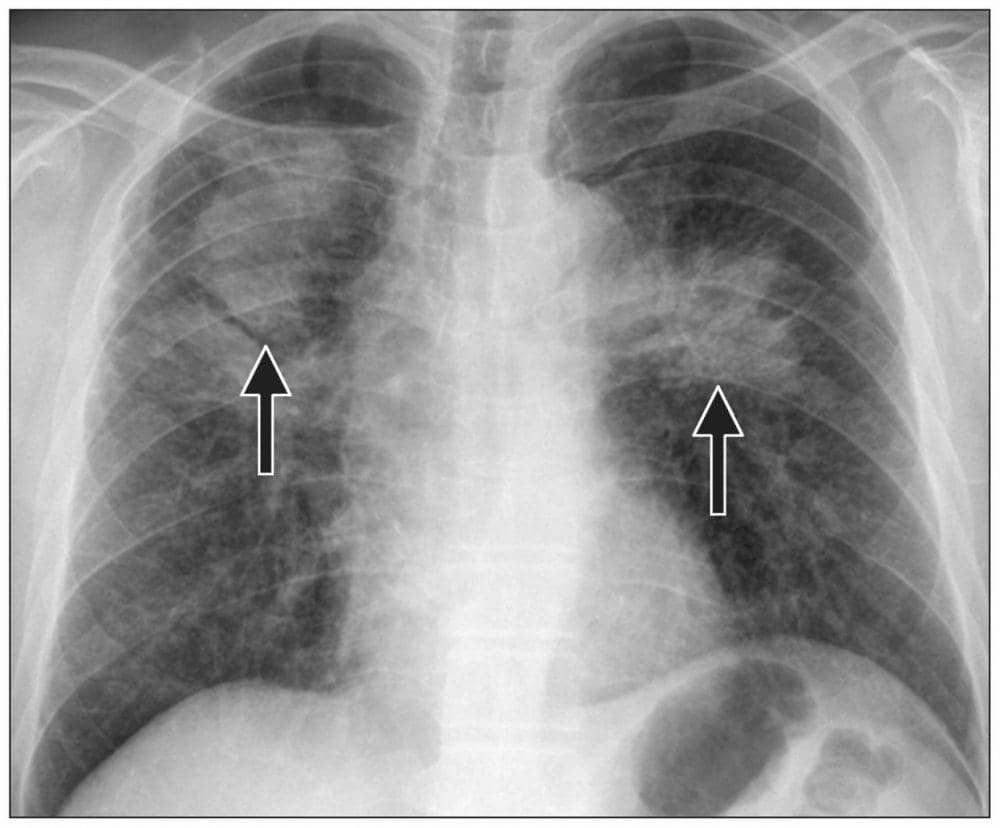ilustrasi paru-paru dengan pneumoconiosis (cmaj.ca/Justin Cheng-Ta Yang, Kao-Lang Liu)