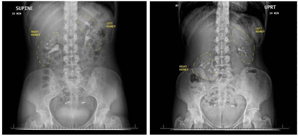 ilustrasi nephroptosis (livescience.com/Akshay Sood/BMJ Case Reports 2018)