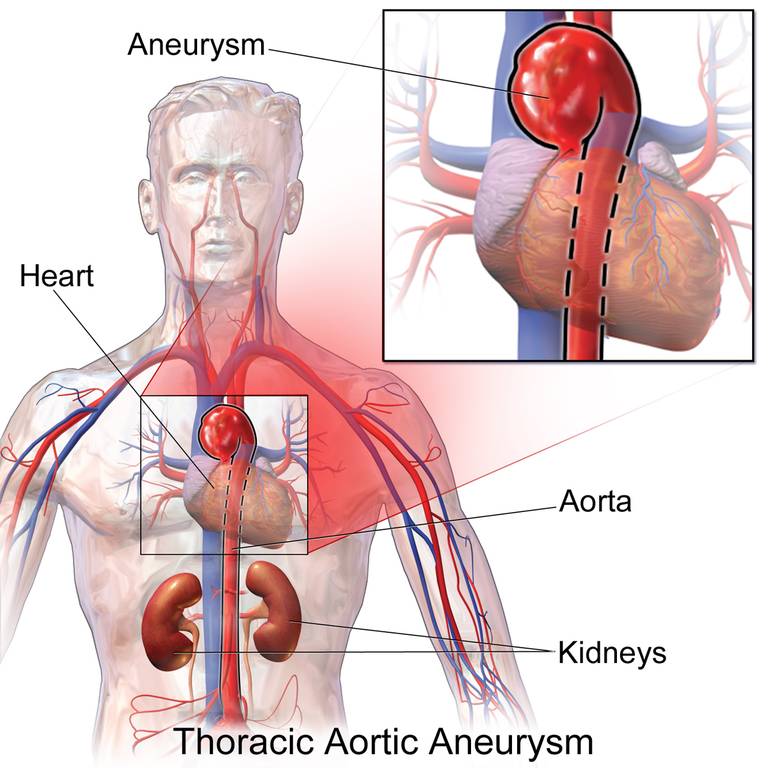 ilustrasi aneurisme aorta toraks (commons.wikimedia.org/BruceBlaus)