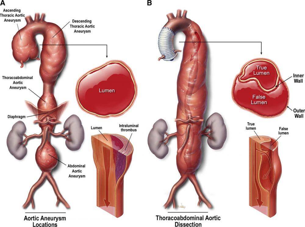 ilustrasi jenis aneurisme aorta (ahajournals.org)