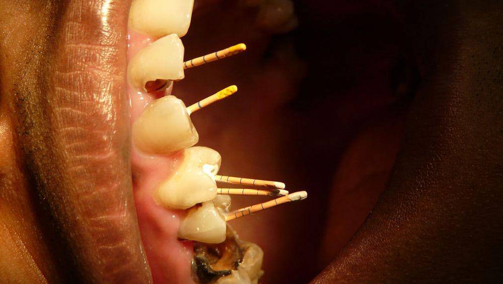 ilustrasi perawatan saluran akar gigi atau perawatan endodontik (commons.wikimedia.org/Dr. Partha Sarathi Sahana)