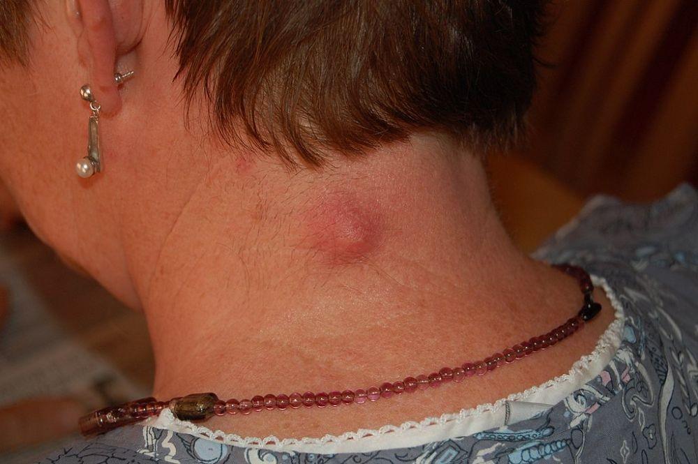 Kista Epidermoid: Gejala, Penyebab, Diagnosis, Pengobatan