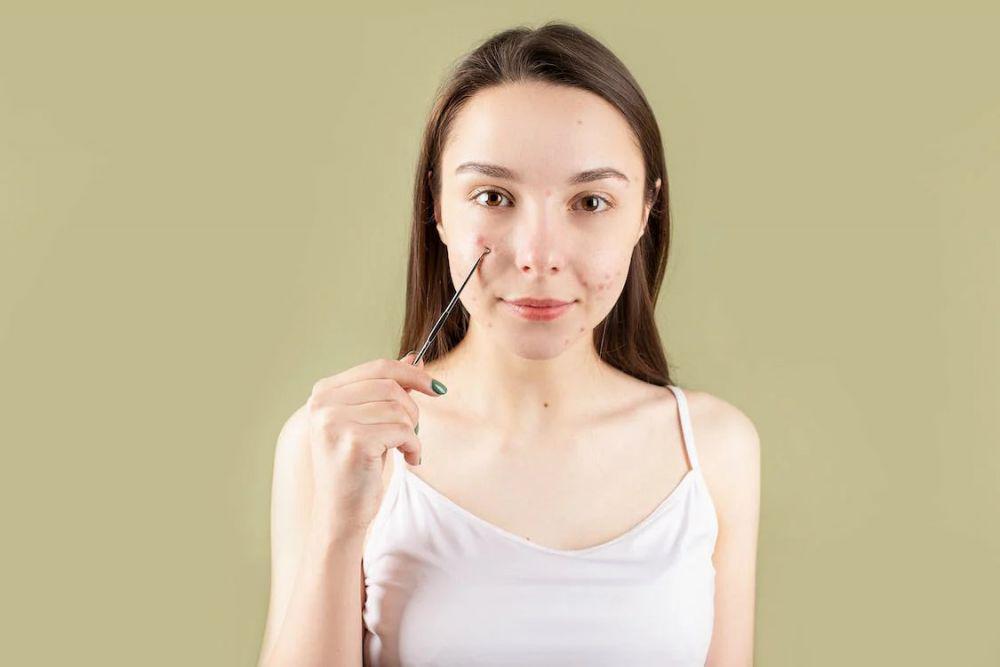 5 Kebiasaan Sepele yang Picu Timbulnya Jerawat, Jangan Dilakukan!