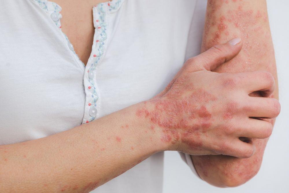 7 Cara agar Psoriasis Tidak Kambuh, Penting Diketahui!