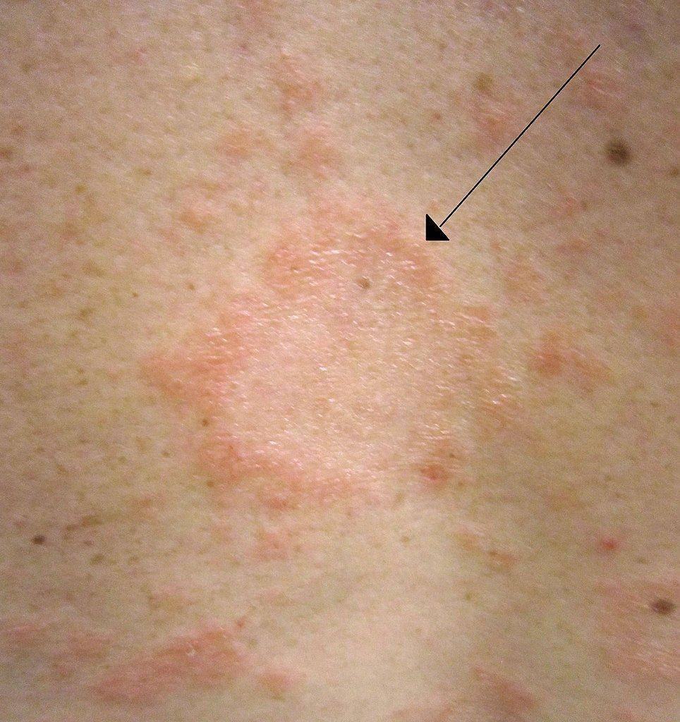 ilustrasi herald patch pada kondisi pityriasis rosea (commons.wikimedia.org/James Heilman,MD)