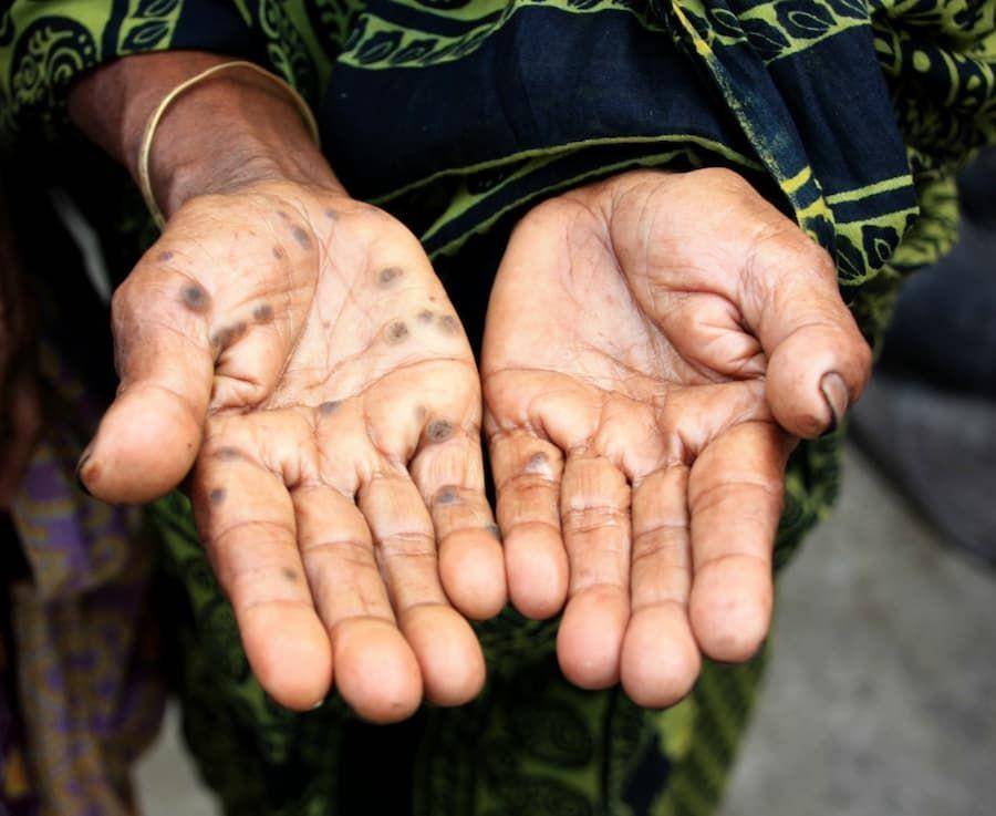 ilustrasi akibat paparan racun arsenik (commons.wikimedia.com/Anita Ghosh-REACH)