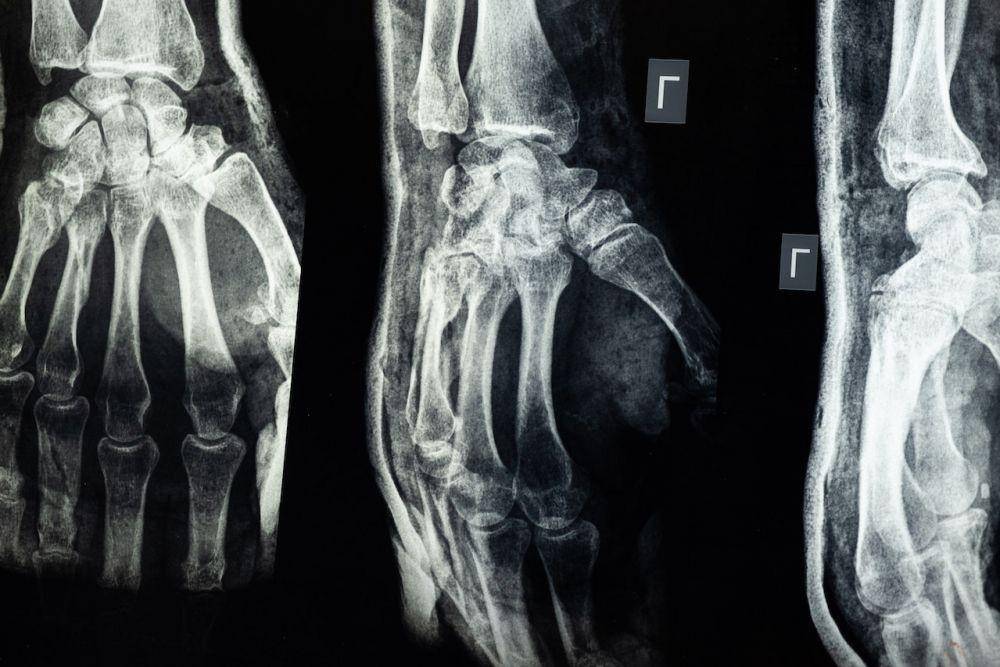 ilustrasi diagnosis osteopetrosis (pexels.com/cottonbro)