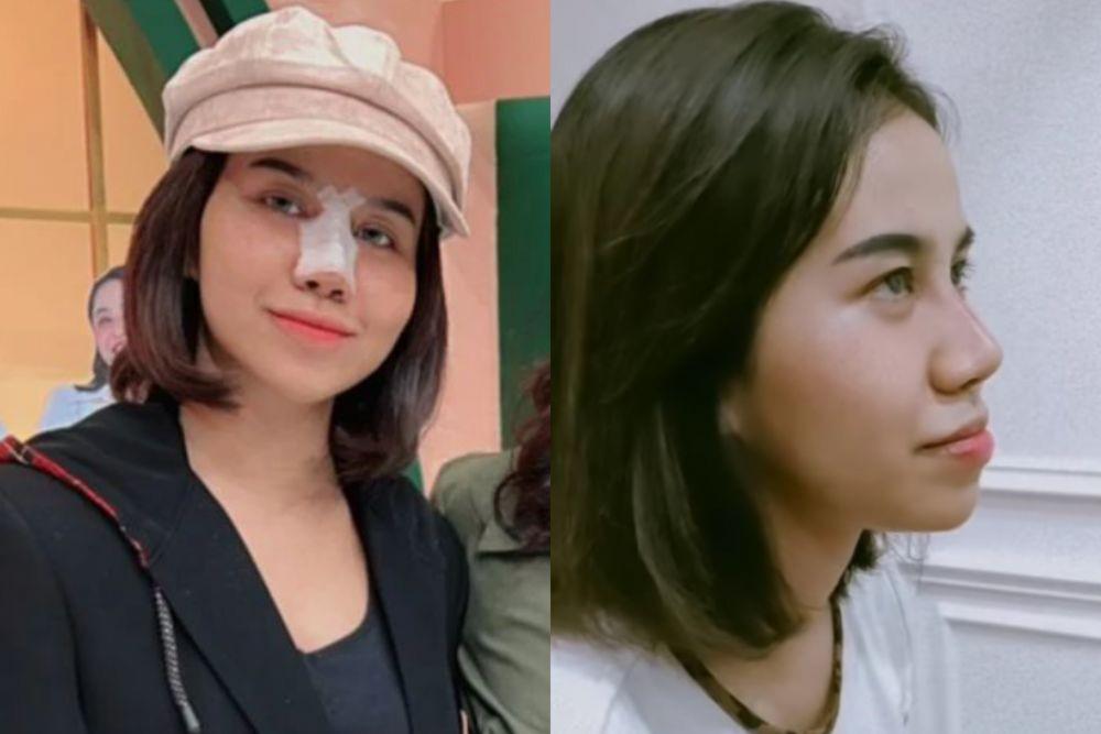 10 Potret Wajah Baru Mayang Adik Vanessa Angel Usai Operasi Hidung