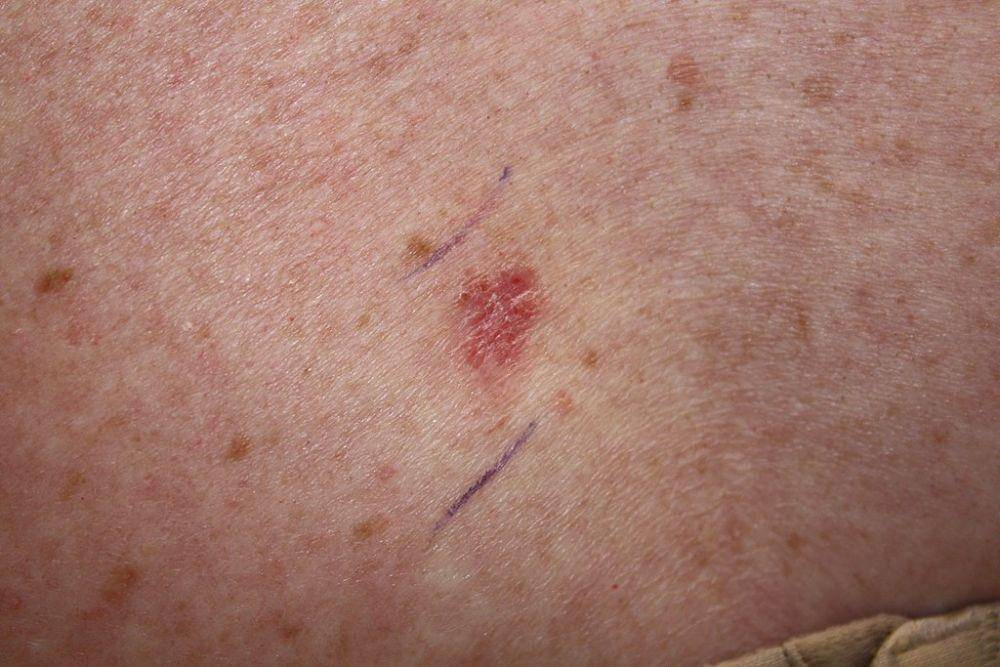 Lesi kanker kulit (karsinoma sel basal). (commons.wikimedia.org/Kelly Nelson, M.D.)