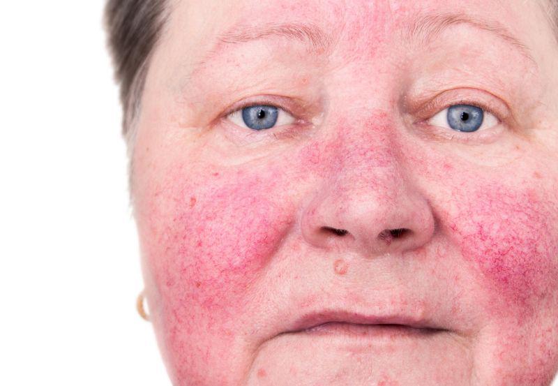 5 Pengobatan Rumahan untuk Meredakan Rosacea