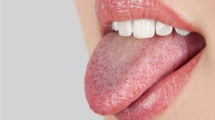 5 Cara Meredakan Mulut Kering, Hindari Jus Asam dan Selalu Terhidrasi!