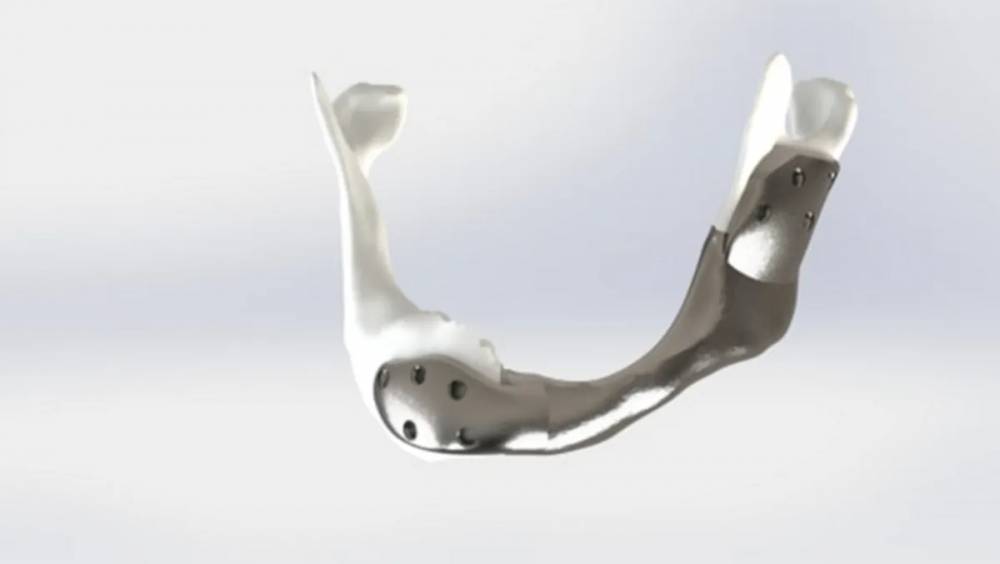 rahang titanium produksi M3DT dan Netherlands Cancer Institute (iflscience.com)