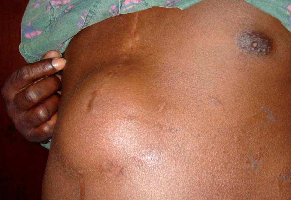 ilustrasi hernia epigastrik (commons.wikimedia.org/PacoPeramo)