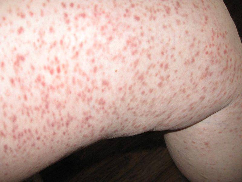 Urtikaria pigmentosa dari mastocytosis. (flickr.com/Mastocytosis Canada)