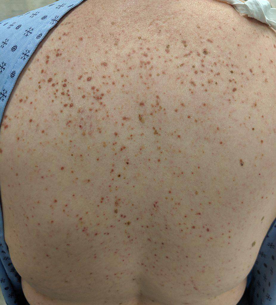 ilustrasi mastocytosis (commons.wikimedia.org/Doc James)