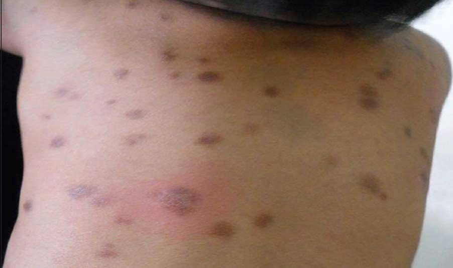 Urtikaria pigmentosa pada bayi dengan mastocytosis (commons.wikimedia.org/Journal of Biosciences and Medicines 07 (06): 33–58/Damilola Runsewe)