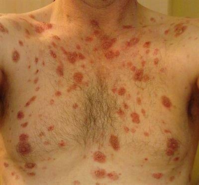 ilustrasi pemfigus foliaceus (frontiersin.org/Front. Med., 09 November 2018)