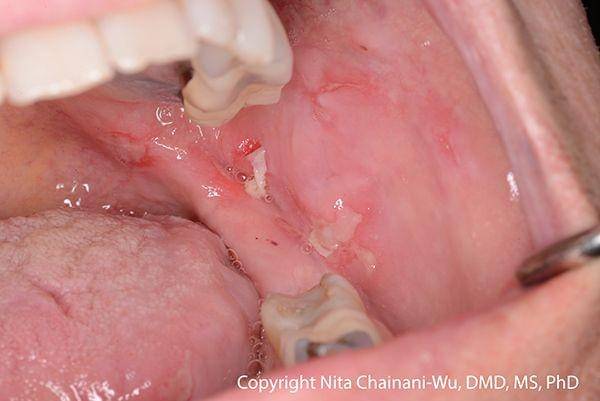 ilustrasi pemfigus (pemphigus.org)