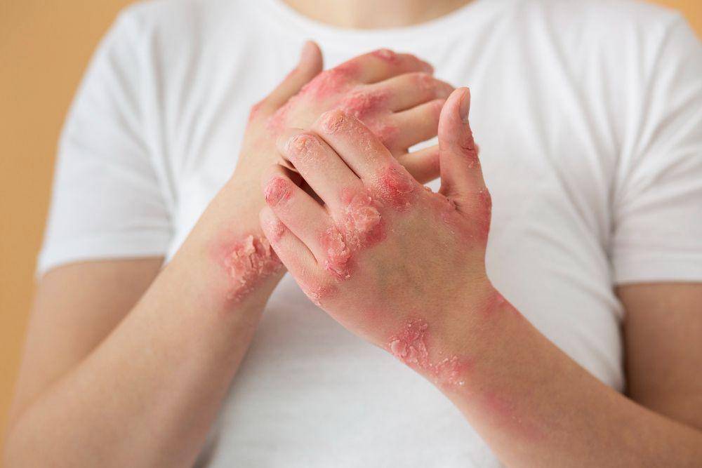ilustrasi seseorang mengidap psoriasis (freepik.com/freepik)