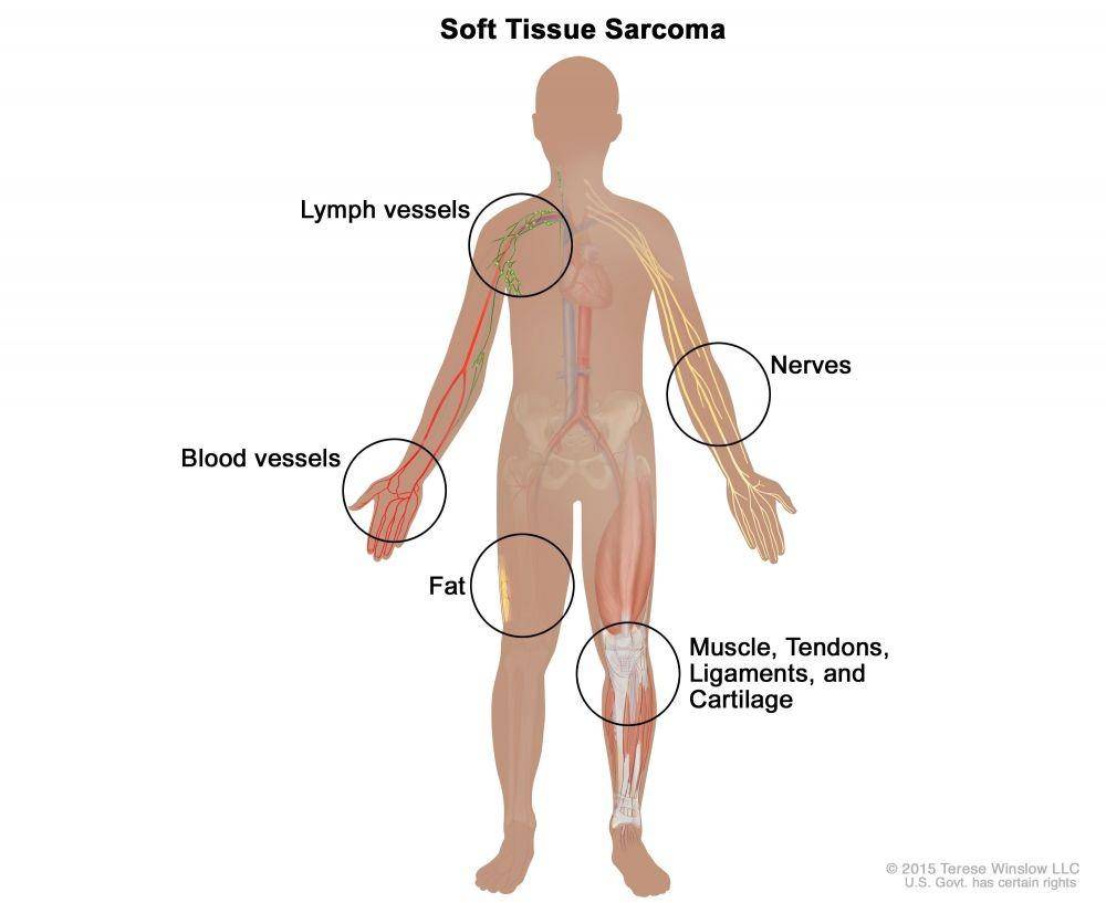 Sarkoma jaringan lunak (cancer.gov/2015 Terese Winslow LLC)