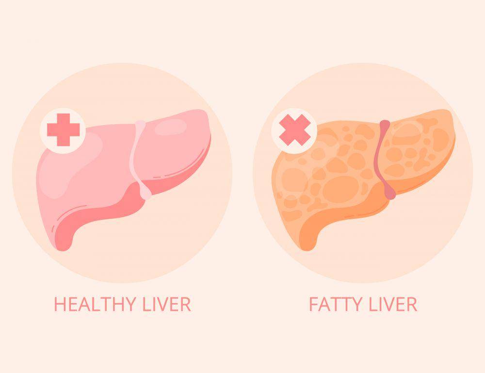 ilustrasi fatty liver (freepik.com/freepik)