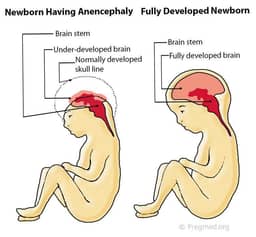 Anencephaly: Penyebab, Gejala, Penanganan, Pencegahan | IDN Times