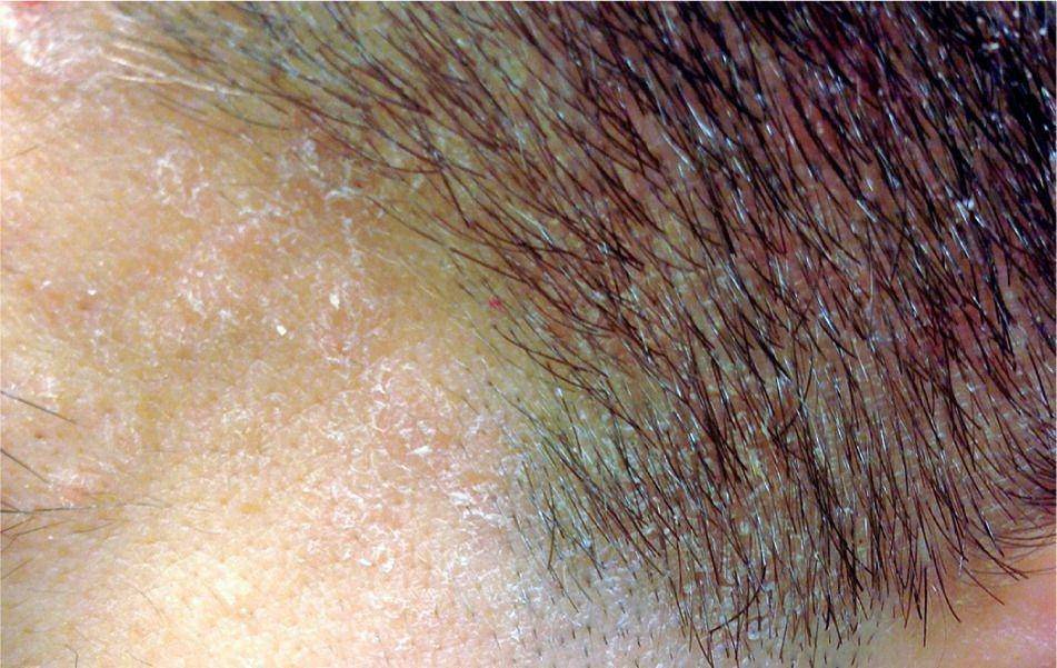 ilustrasi dermatitis seboroik (aafp.org/Am Fam Physician. 2015;91(3):185-190)