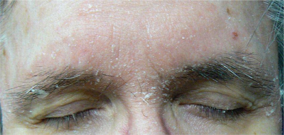 ilustrasi dermatitis seboroik (aafp.org/Am Fam Physician. 2015;91(3):185-190)