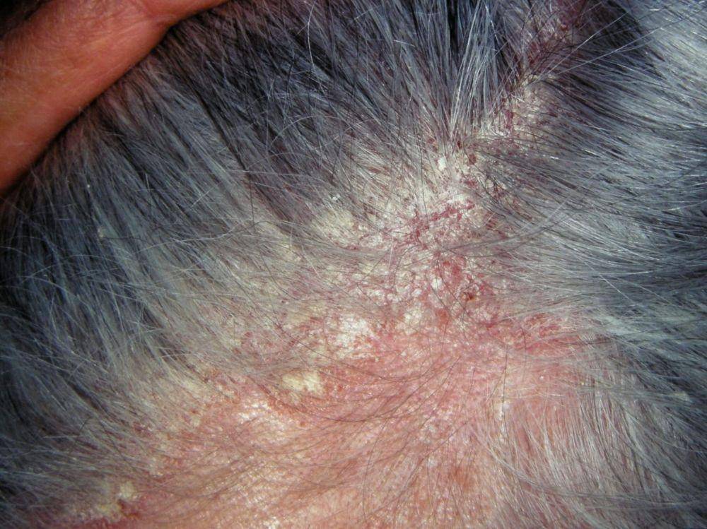 dermatitis seboroik (eczema.org/DermNet New Zealand)