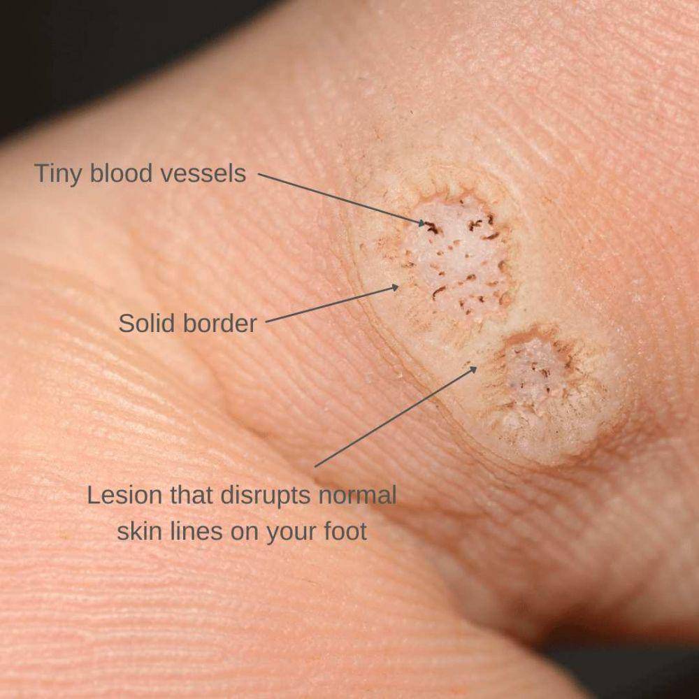 ilustrasi kutil plantar (thefeetpeople.com.au)