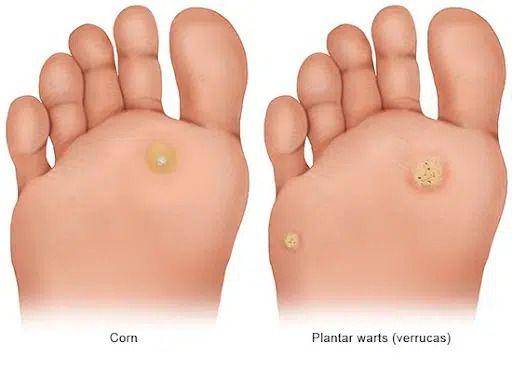 ilustrasi perbedaan kutil plantar dan mata ikan atau corn (solepodiatry.com.au)