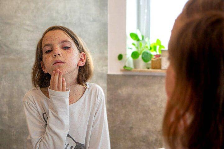 ilustrasi anak dengan penyakit campak