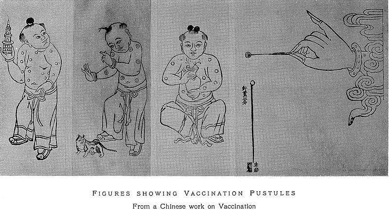 ilustrasi variolasi (commons.wikimedia.org/Wellcome Collection gallery/International Medical Congress)