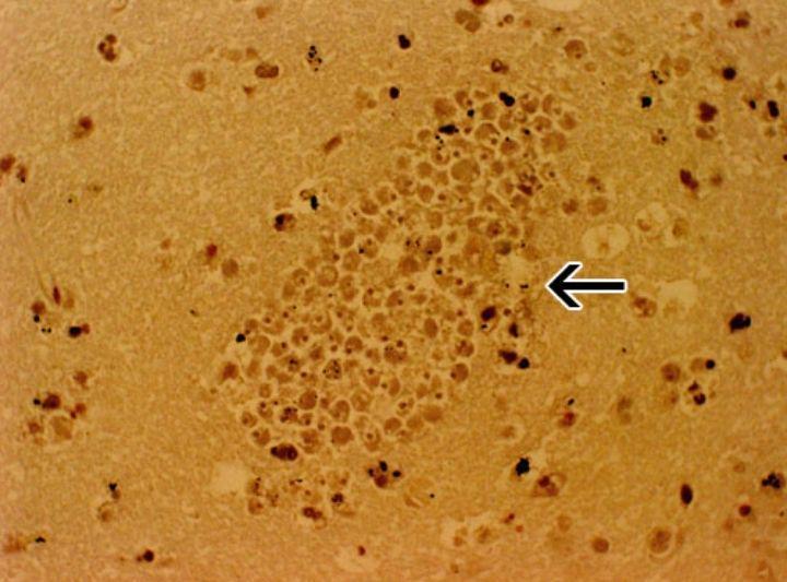 Mengenal Bakteri Pemakan Otak Manusia, Naegleria Fowleri