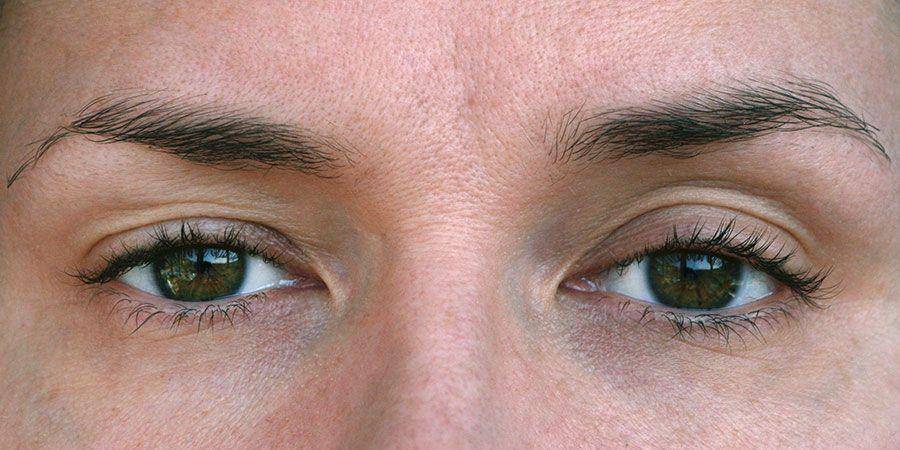ilustrasi ptosis atau kelopak mata turun (aoa.org)